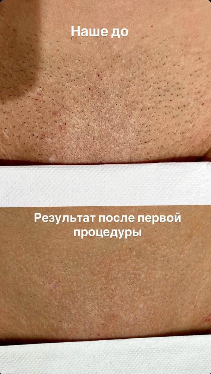 Скидка на лазерную эпиляцию в Стокгольме — фото 2