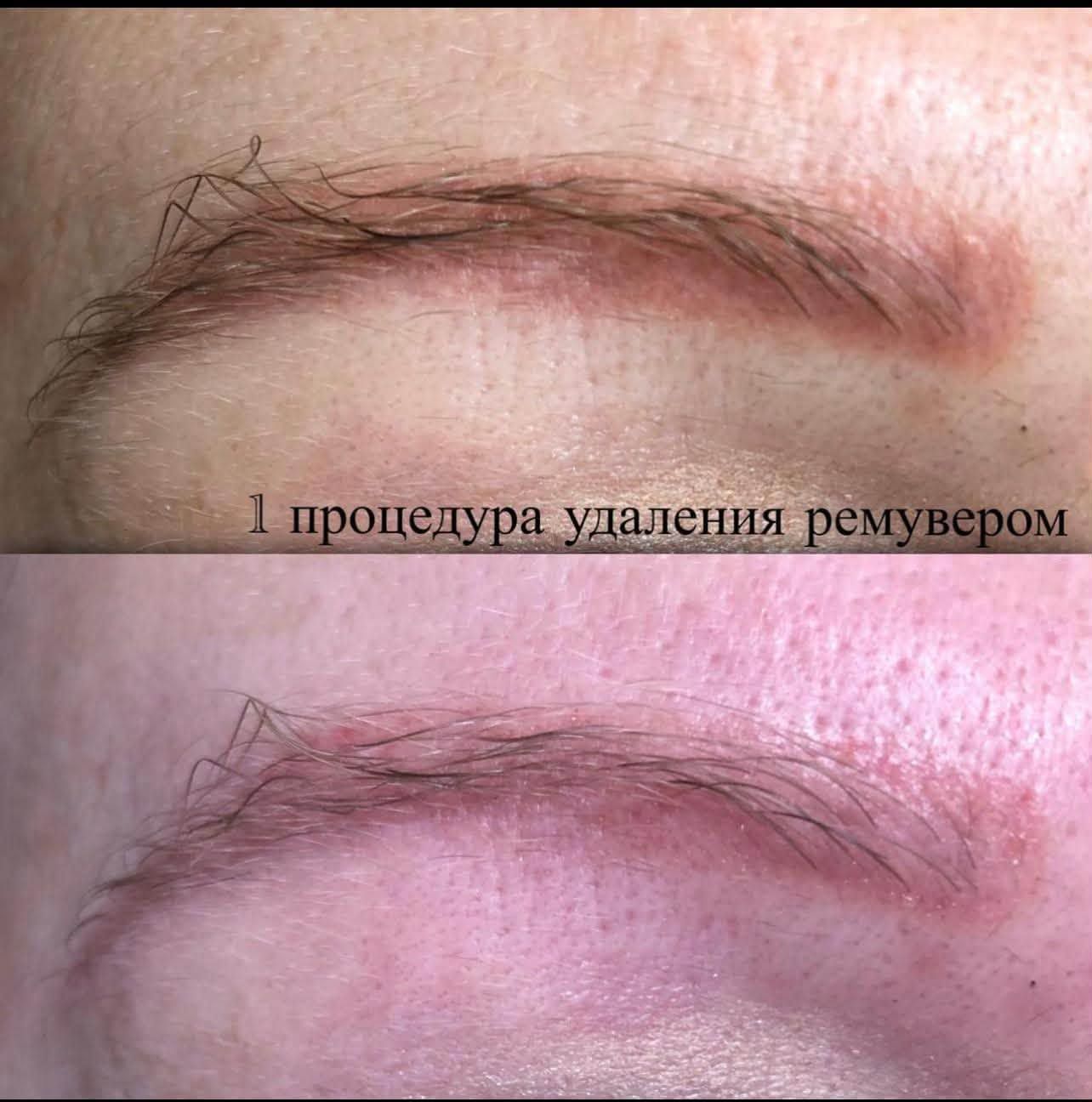 Интенсив по удалению перманентного макияжа в Стокгольме — фото 3